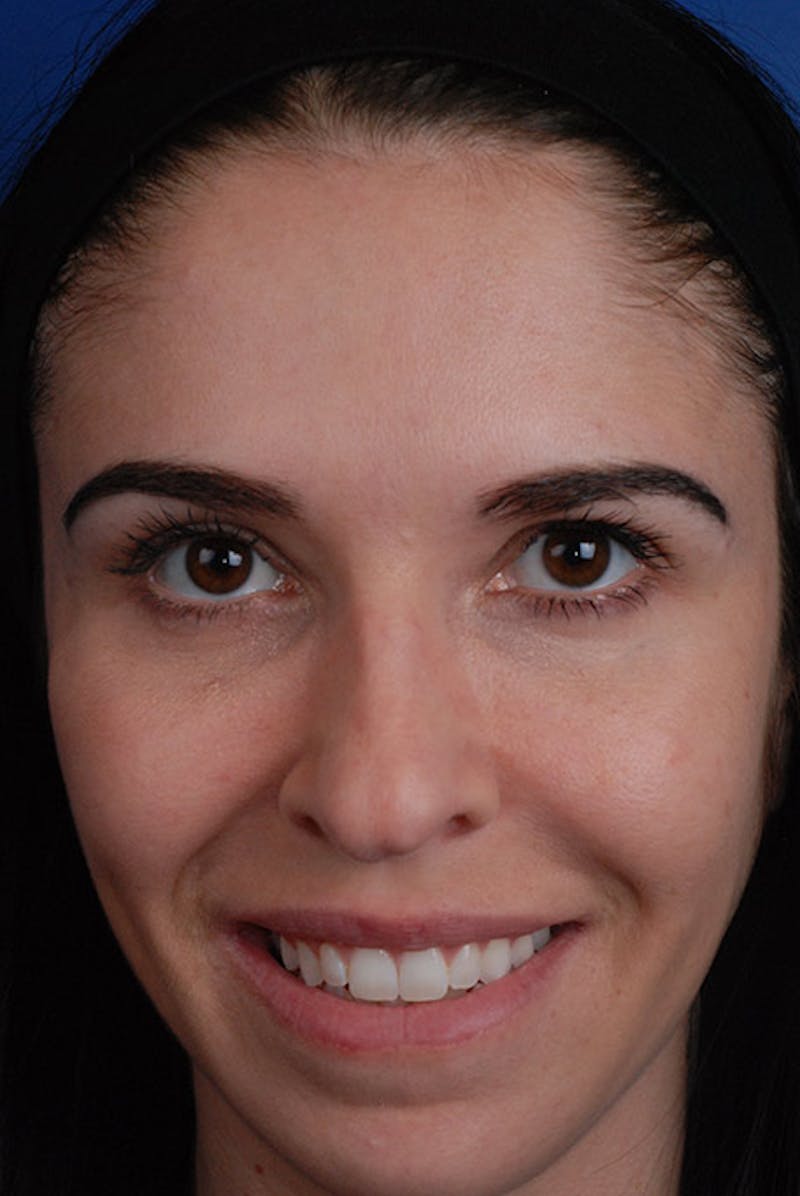 Botox Before & After Gallery - Patient 12973237 - Image 4