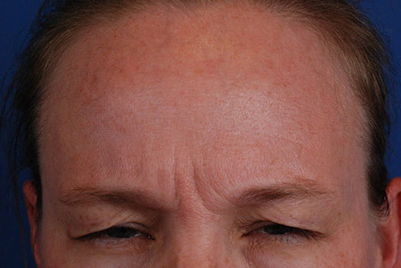 Botox Before & After Gallery - Patient 12973239 - Image 1