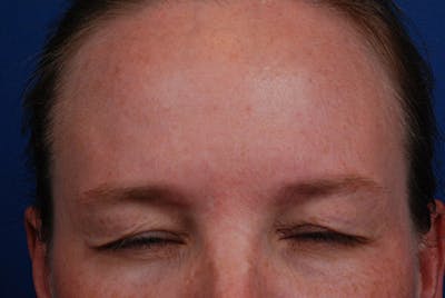 Botox Before & After Gallery - Patient 12973239 - Image 2