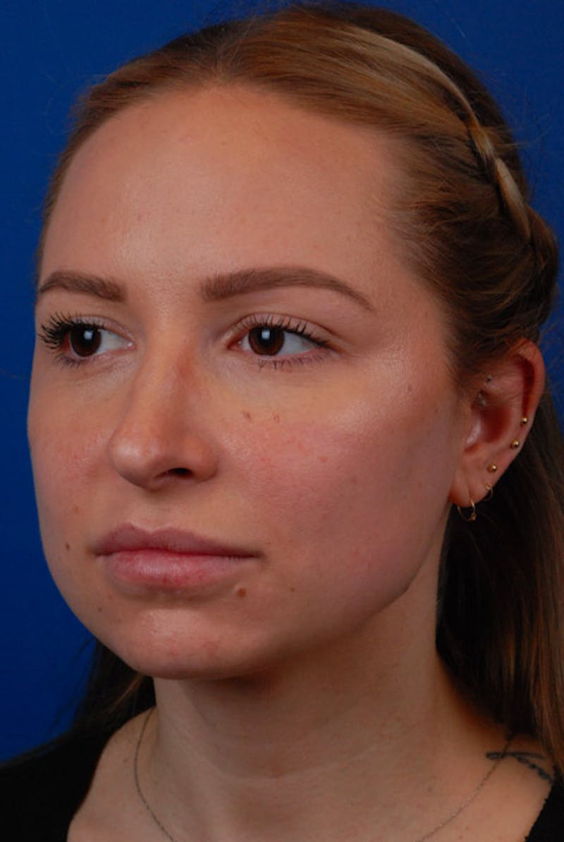 Botox Before & After Gallery - Patient 12973243 - Image 1