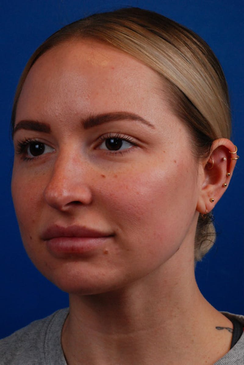 Botox Before & After Gallery - Patient 12973243 - Image 2