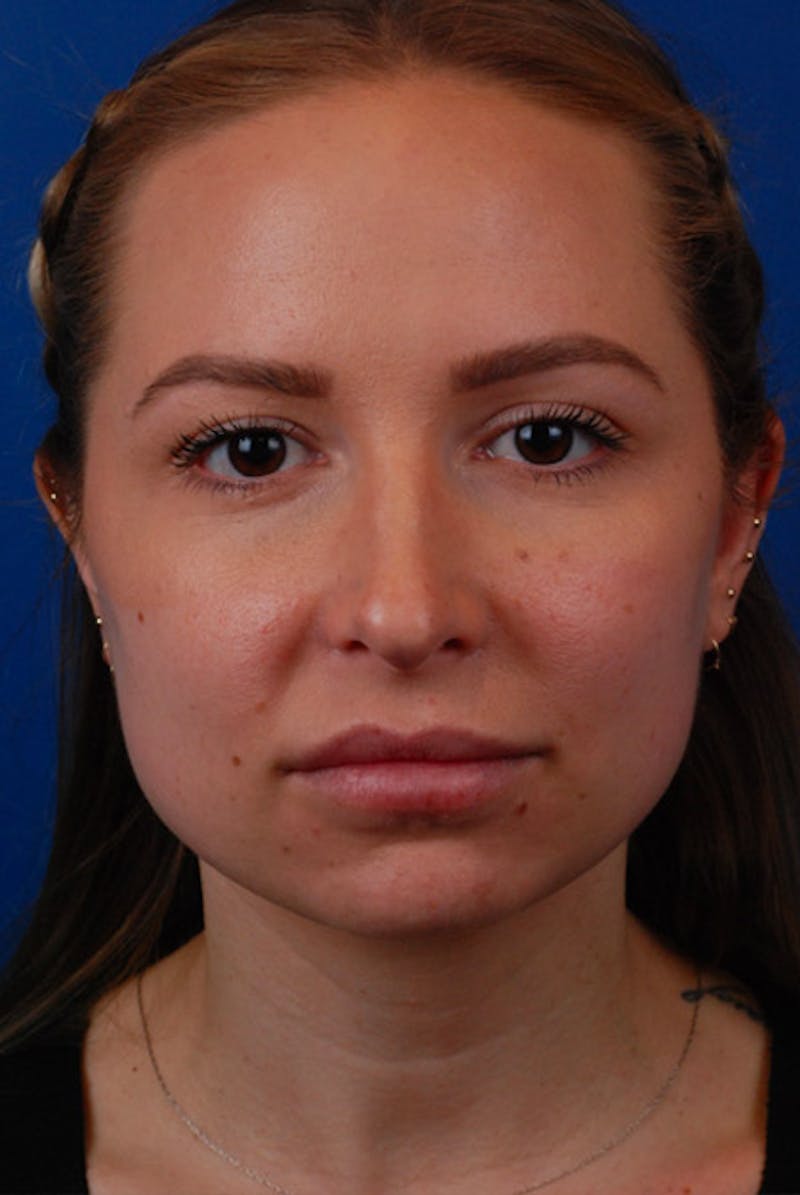 Botox Before & After Gallery - Patient 12973243 - Image 3