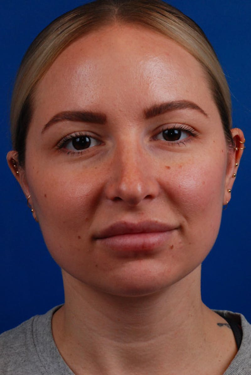 Botox Before & After Gallery - Patient 12973243 - Image 4
