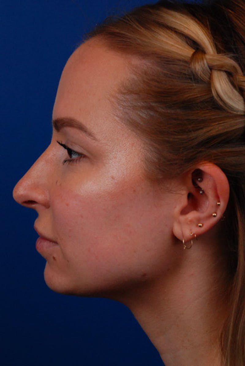 Botox Before & After Gallery - Patient 12973243 - Image 5