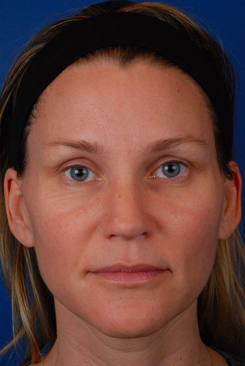 Botox Before & After Gallery - Patient 12973351 - Image 2
