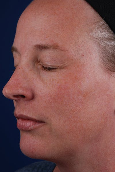 Chemical Peel Before & After Gallery - Patient 12973775 - Image 1