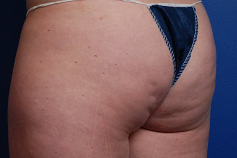 Cellfina Before & After Gallery - Patient 12973777 - Image 3