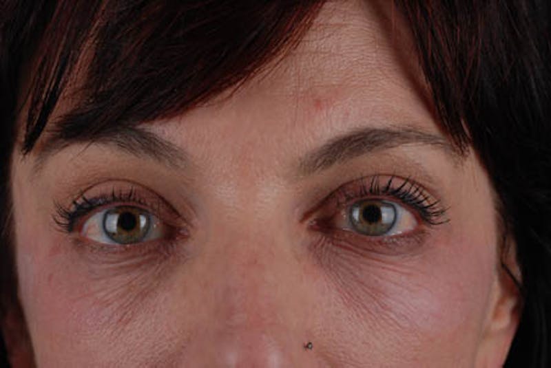 Chemical Peel Before & After Gallery - Patient 12973778 - Image 1