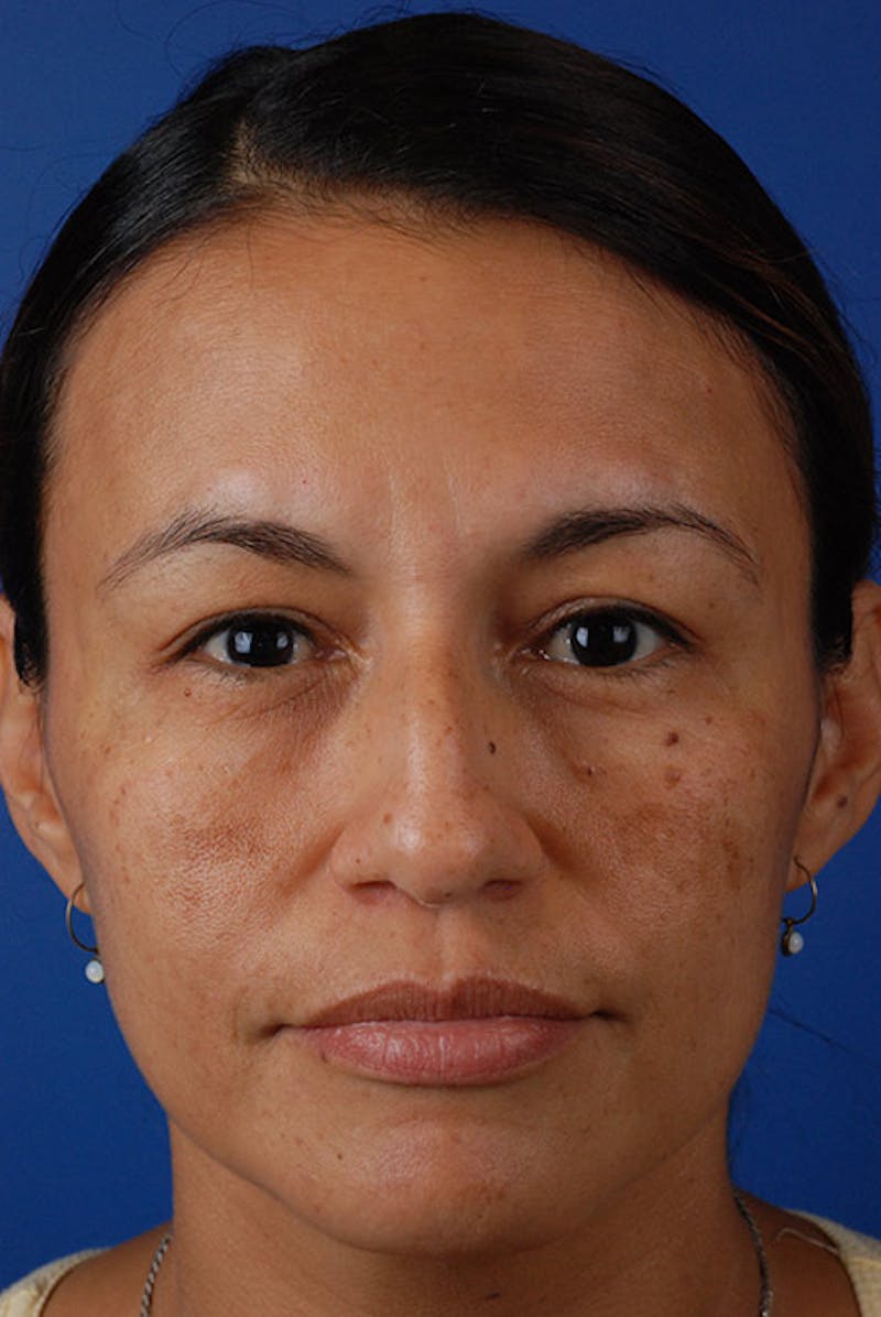 Chemical Peel Gallery - Patient 12973782 - Image 1
