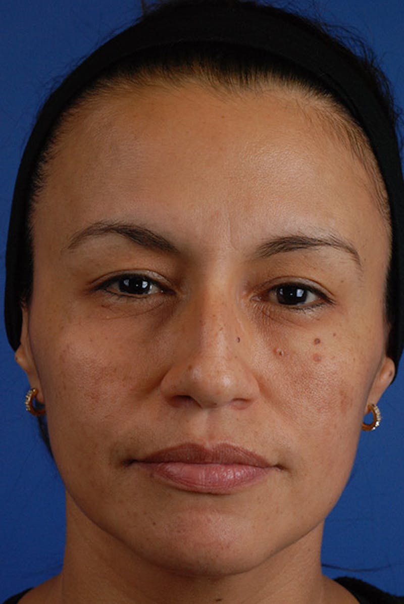 Chemical Peel Before & After Gallery - Patient 12973782 - Image 2