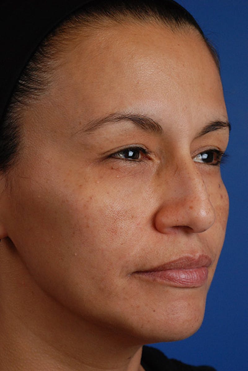 Chemical Peel Before & After Gallery - Patient 12973782 - Image 4
