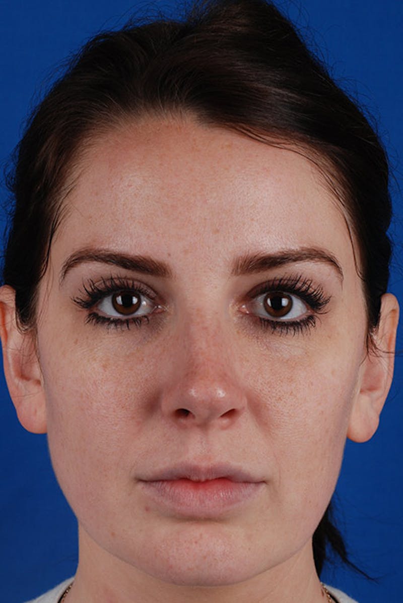 Chemical Peel Before & After Gallery - Patient 12973788 - Image 1