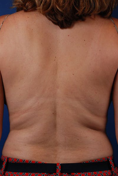 Coolsculpting Before & After Gallery - Patient 12973789 - Image 1