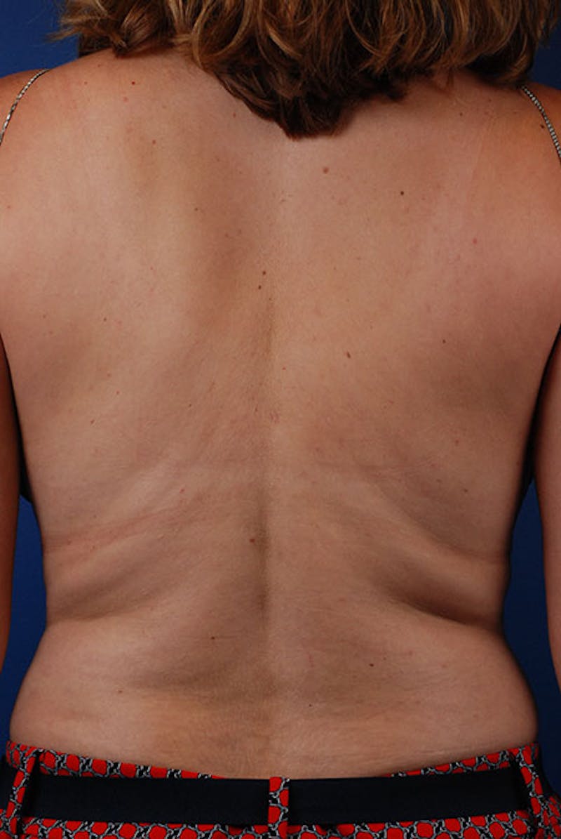 Coolsculpting Gallery - Patient 12973789 - Image 1