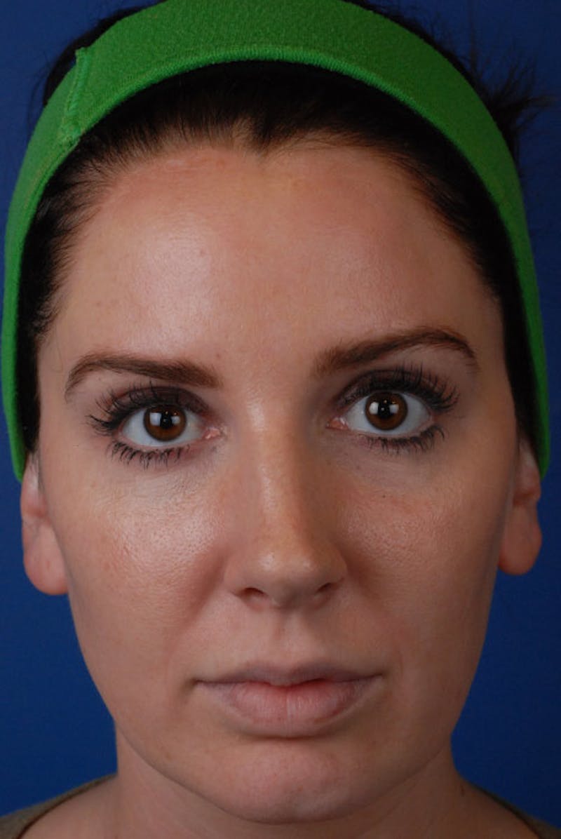 Chemical Peel Before & After Gallery - Patient 12973788 - Image 2