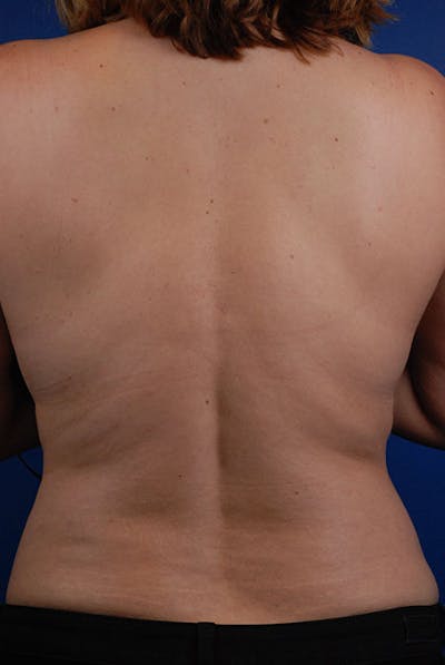 Coolsculpting Before & After Gallery - Patient 12973789 - Image 2