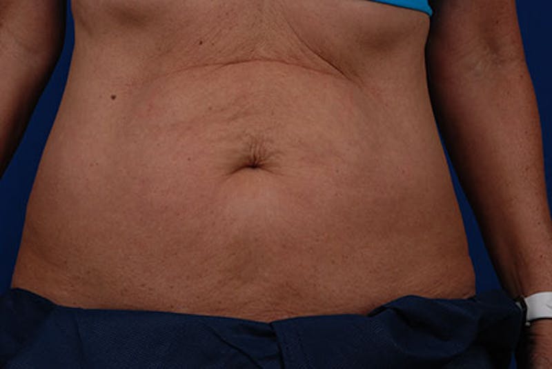 Coolsculpting Before & After Gallery - Patient 12973795 - Image 1