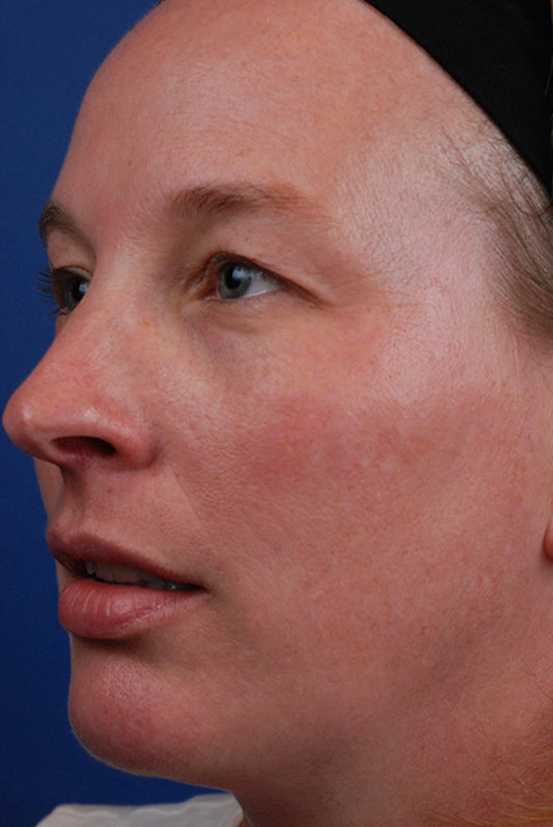 Chemical Peel Before & After Gallery - Patient 12973792 - Image 2