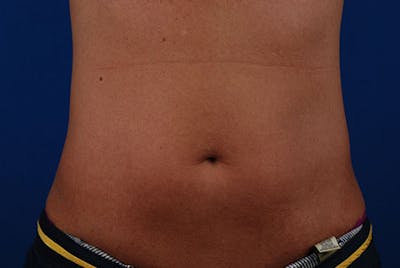 Coolsculpting Before & After Gallery - Patient 12973795 - Image 2