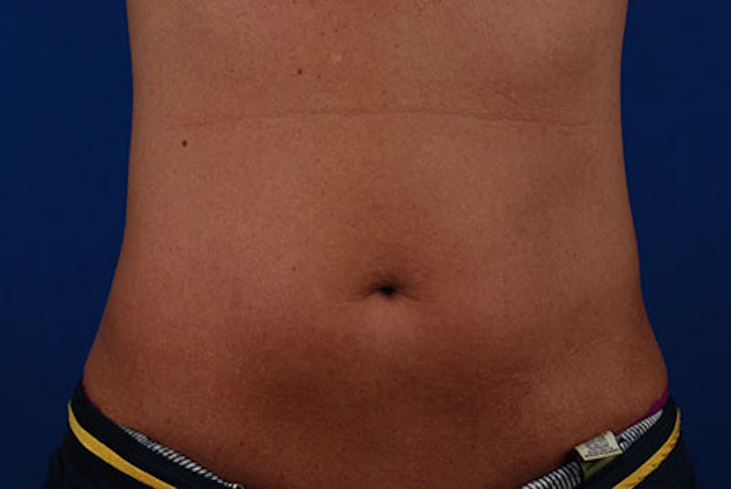 Coolsculpting Gallery - Patient 12973795 - Image 2