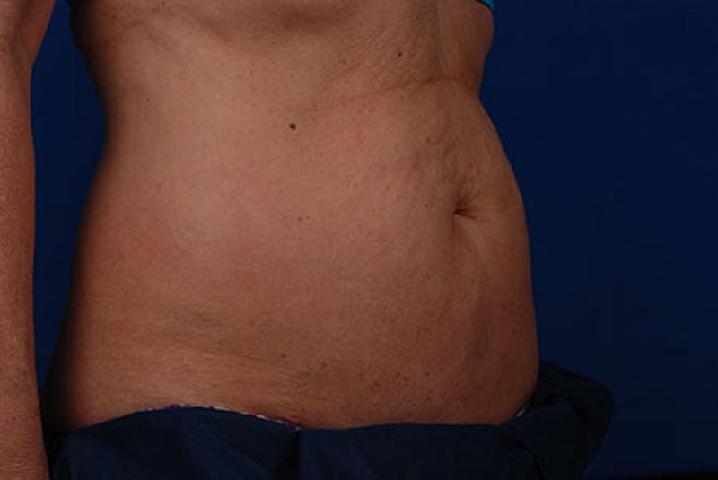 Coolsculpting Gallery - Patient 12973795 - Image 3