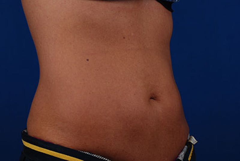 Coolsculpting Before & After Gallery - Patient 12973795 - Image 4