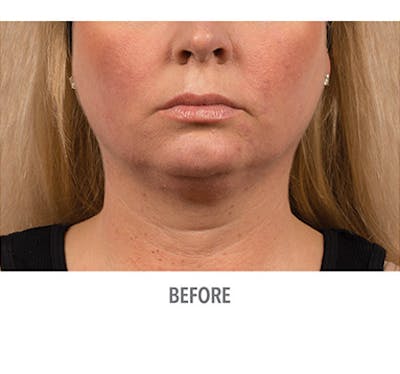 CoolSculpt Mini Before & After Gallery - Patient 12973797 - Image 1