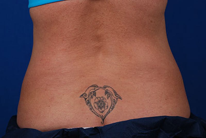 Coolsculpting Before & After Gallery - Patient 12973795 - Image 5
