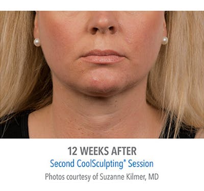 CoolSculpt Mini Before & After Gallery - Patient 12973797 - Image 2