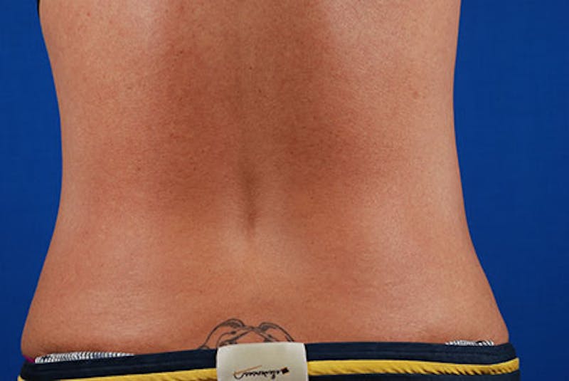 Coolsculpting Before & After Gallery - Patient 12973795 - Image 6