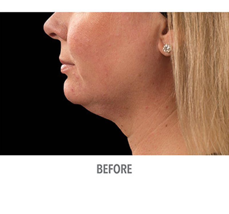 CoolSculpt Mini Before & After Gallery - Patient 12973797 - Image 3