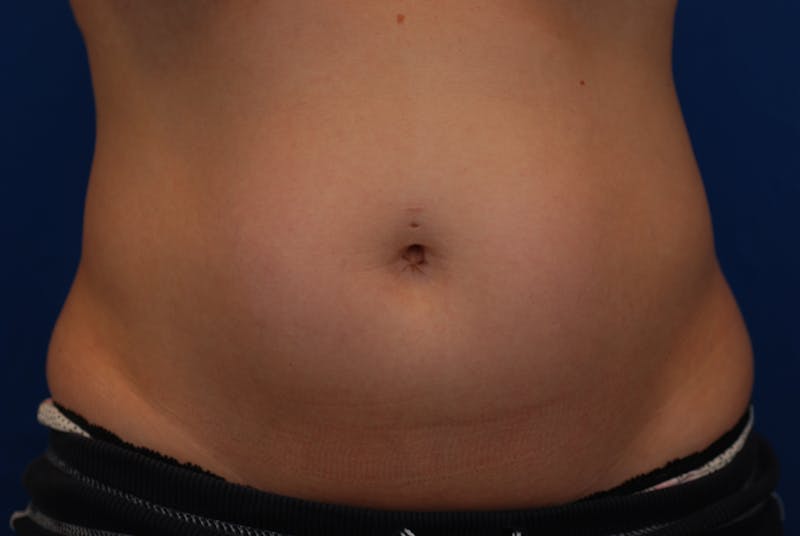 Coolsculpting Before & After Gallery - Patient 12973815 - Image 1