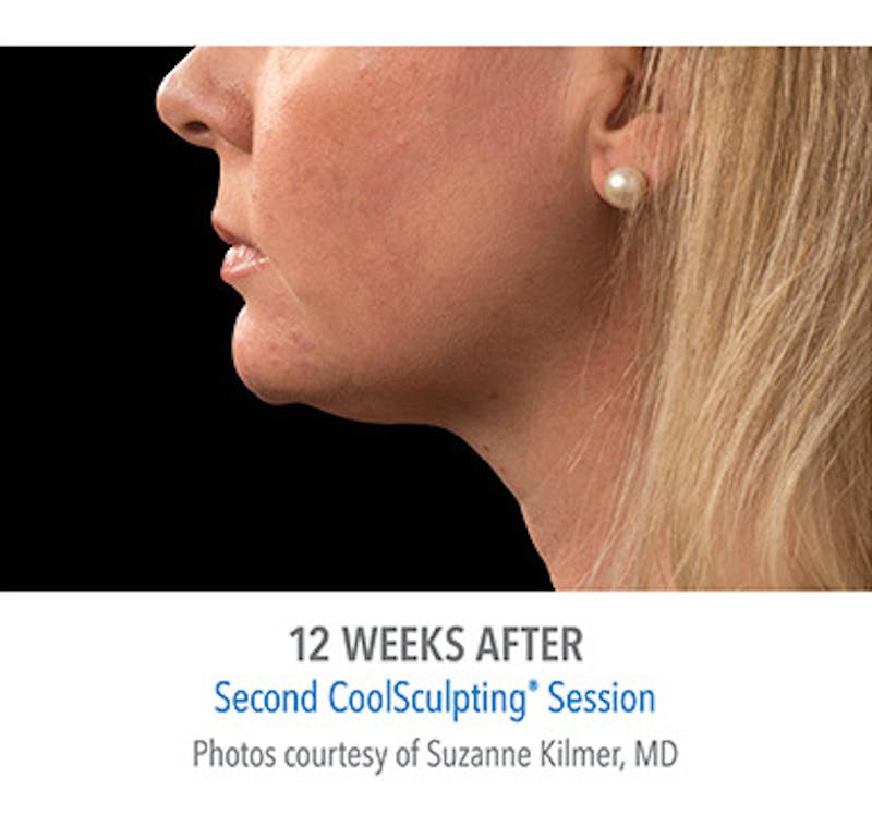 CoolSculpt Mini Before & After Gallery - Patient 12973797 - Image 4