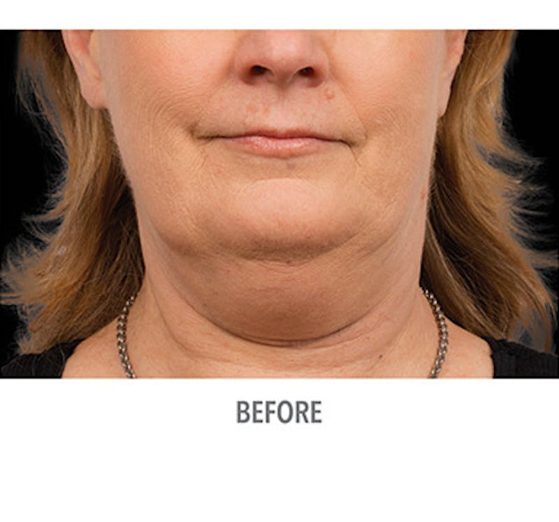 CoolSculpt Mini Before & After Gallery - Patient 12973801 - Image 1