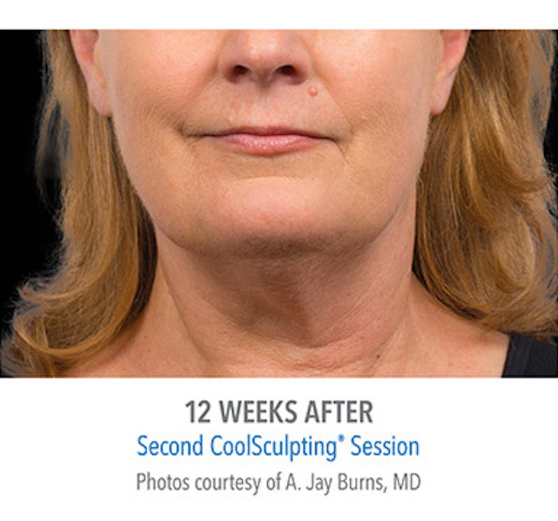 CoolSculpt Mini Before & After Gallery - Patient 12973801 - Image 2