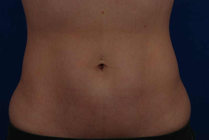 Coolsculpting Before & After Gallery - Patient 12973815 - Image 2