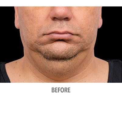 CoolSculpt Mini Before & After Gallery - Patient 12973806 - Image 1