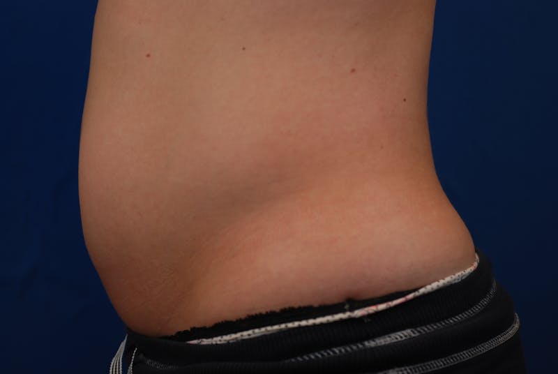 Coolsculpting Before & After Gallery - Patient 12973815 - Image 3