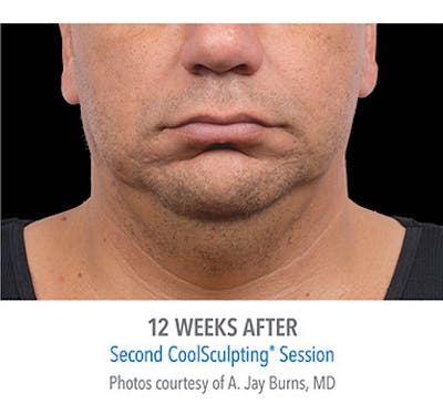 CoolSculpt Mini Before & After Gallery - Patient 12973806 - Image 2
