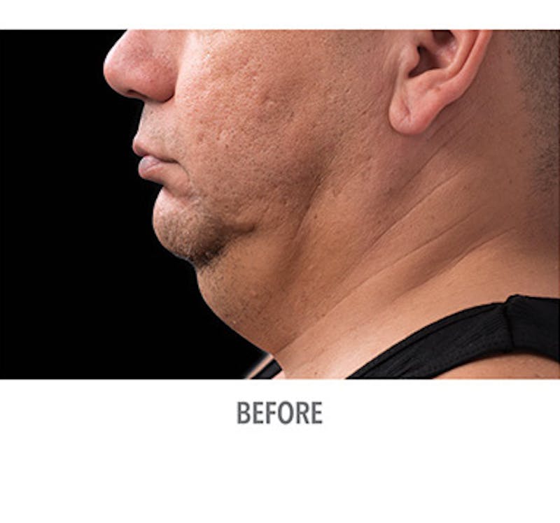 CoolSculpt Mini Before & After Gallery - Patient 12973806 - Image 3