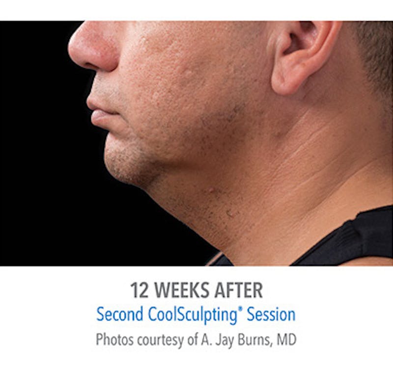 CoolSculpt Mini Before & After Gallery - Patient 12973806 - Image 4