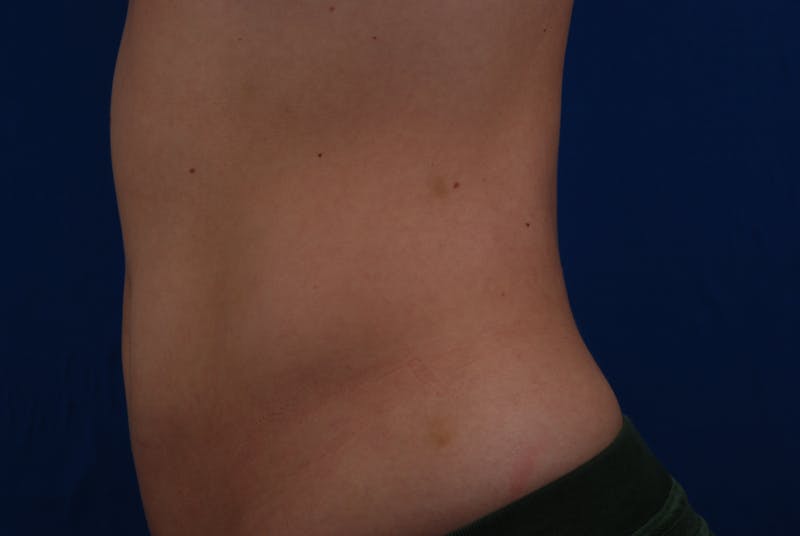 Coolsculpting Before & After Gallery - Patient 12973815 - Image 4