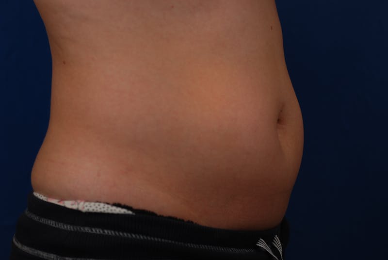 Coolsculpting Before & After Gallery - Patient 12973815 - Image 5