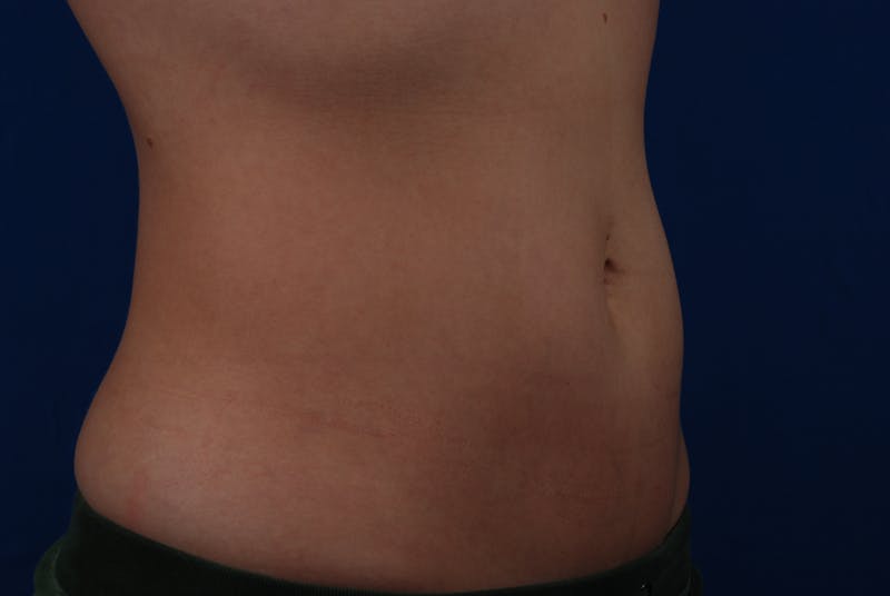 Coolsculpting Gallery - Patient 12973815 - Image 6