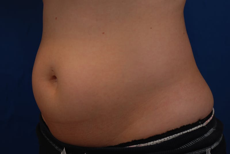 Coolsculpting Before & After Gallery - Patient 12973815 - Image 7