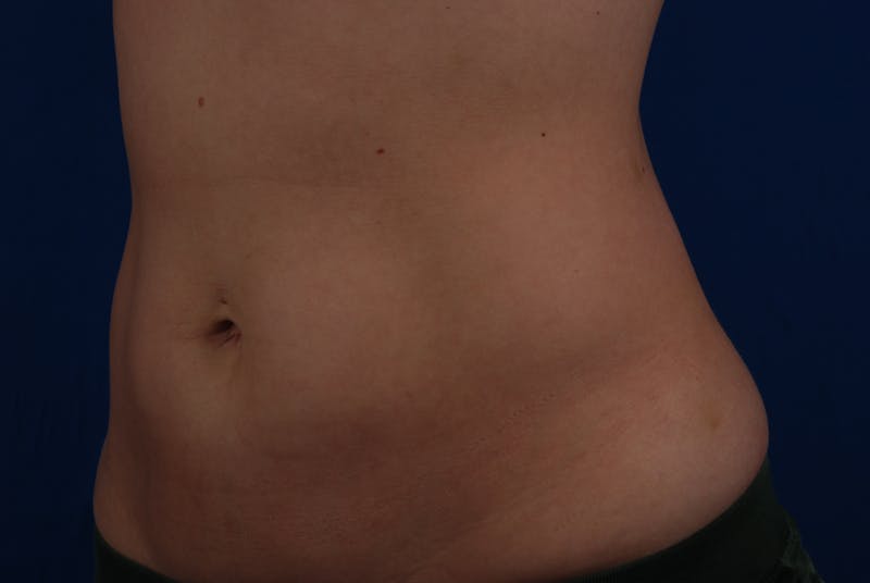 Coolsculpting Gallery - Patient 12973815 - Image 8