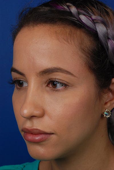 Cheeks Before & After Gallery - Patient 12973813 - Image 1