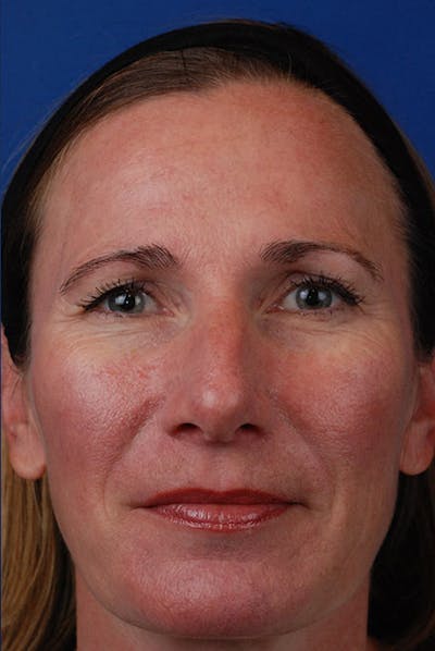Around The Mouth Before & After Gallery - Patient 12973816 - Image 2