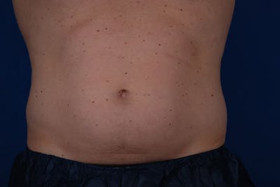 Coolsculpting Before & After Gallery - Patient 12973820 - Image 1