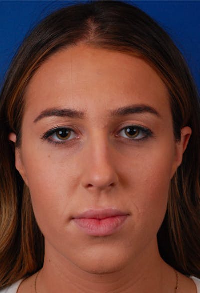 Cheeks Before & After Gallery - Patient 12973818 - Image 2